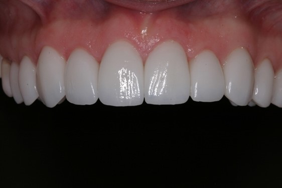 Jessica After - McCreight Progressive Dentistry Veneers