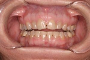 Before - Steamboat Dentistry cosmetic smile makeover