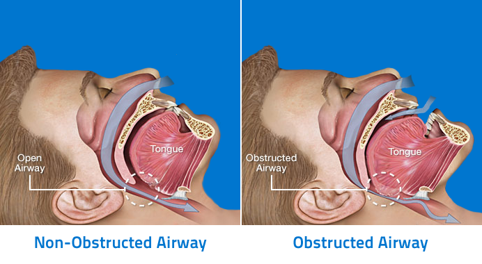 Obstructed Airway