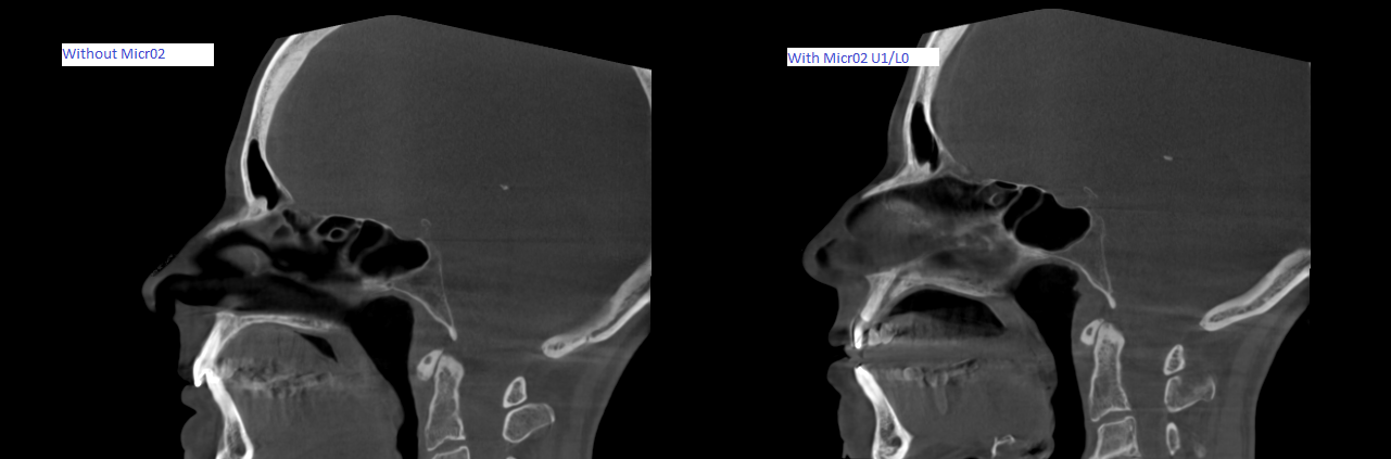 Picture shows device opening up the airway dramatically. 