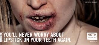 Meth mouth