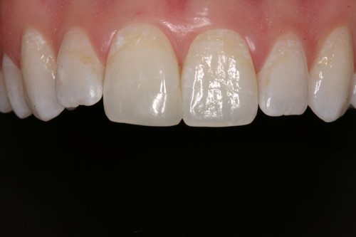 Large Chipped Tooth Restored with a Direct Resin