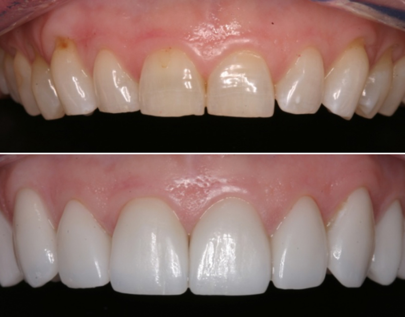 Smile Makeover with Porcelain Veneers