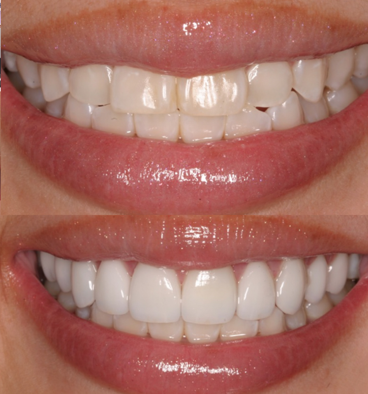 Smile Makeover with Porcelain Veneers