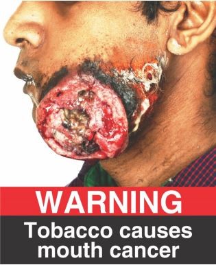 Tobacco causes mouth cancer