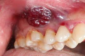 Oral Cancer Example