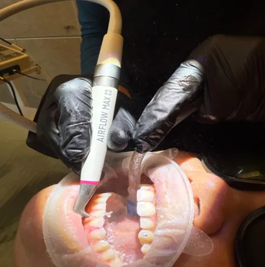 Biofilm procedure photo