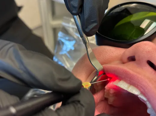 Laser Bacteria Reduction Procedure Photo
